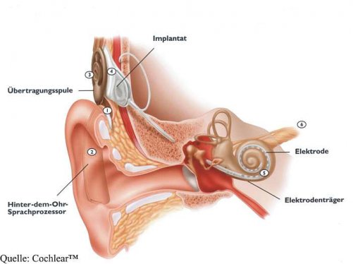 Schemadarstellung eines Cochlea-Implantat-Systems